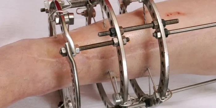 Why-Is-External-Fixation-Used-In-Open-3