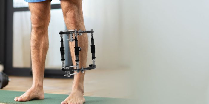 qa-on-post-operative-management-of-deformity-correction-surgery-with-external-fixation